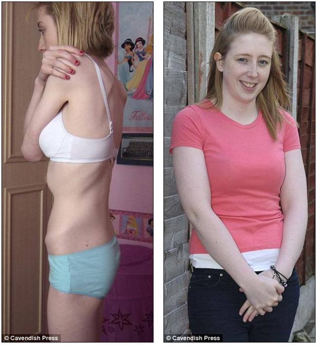 Анорексия: до и после (фото)