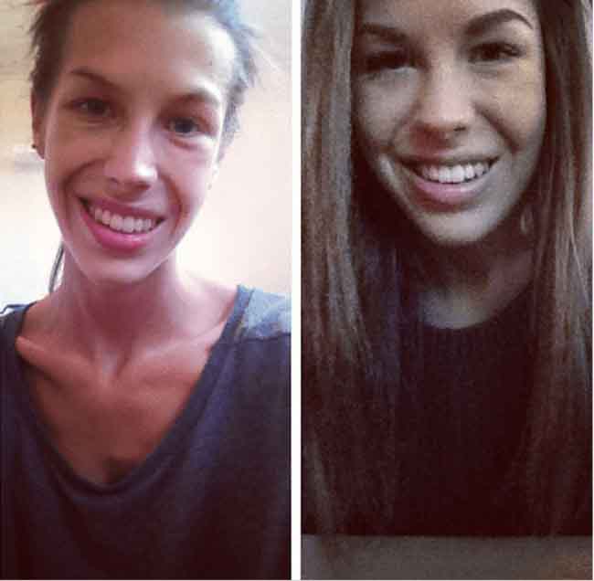 Анорексия: до и после (фото)